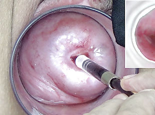 A endoscope japanese camera is inserted in the cervix to watch insi...